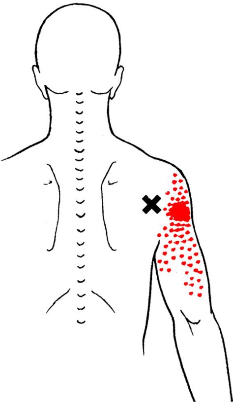 teres major tear test|teres minor referred pain.